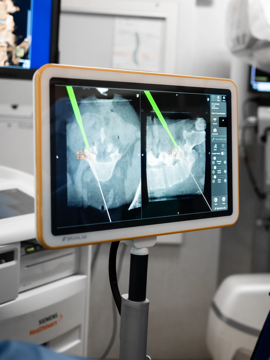 Advanced robotic navigation system displaying real-time spinal imaging for precision-guided spine surgery by Dr Jaytesh Pillay.
