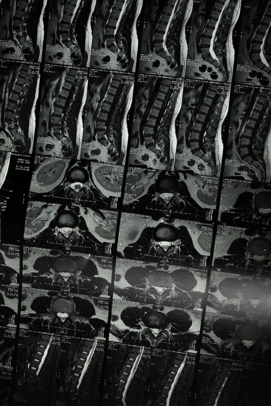 MRI scans of the spine used to diagnose scoliosis and spinal deformities for personalised treatment planning by Dr Jaytesh Pillay.