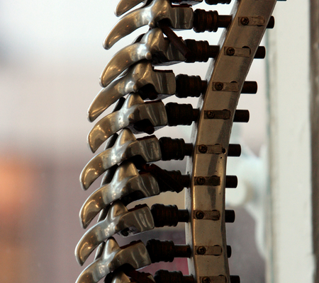 Anatomical spinal model illustrating scoliosis and complex spinal deformity affecting spinal alignment
